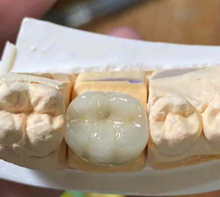 Beli Precision Esthetic Strong Dental PFM Porselen Digabungkan Dengan Mahkota Logam Dalam Kedokteran Gigi pembuatan online
