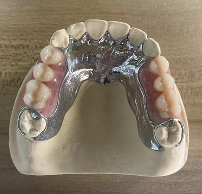 High Strength Casting Metal Partial Denture Cocr Aolly Dengan Pencetakan 3D