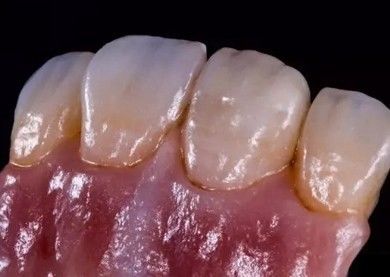 Jerman Amanjilbach Zirconia Dental Crown Densitas Tinggi Dengan kustomisasi