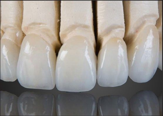 Wieland Zirconia Semua Keramik Mahkota Lukisan Interior Disesuaikan Dengan Desain CAD