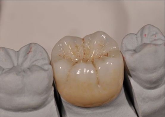 Tinggi Estetika Noritake Zirconia Warna Alam Stabil Untuk Full Zirconia Crown