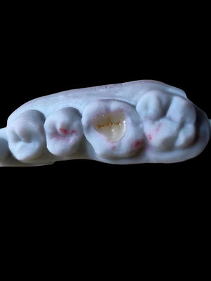 Natural Translucent All Ceramic Dental Emax Onlay Untuk Restorasi Gigi