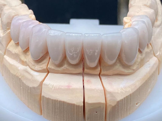Dental Lab E Max Keramik Mahkota tinggi tembus pandang dengan ketahanan korosi