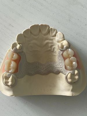 Customized Dental PEEK Akrilik Parsial Dental Adjustable Dengan Pas Aman