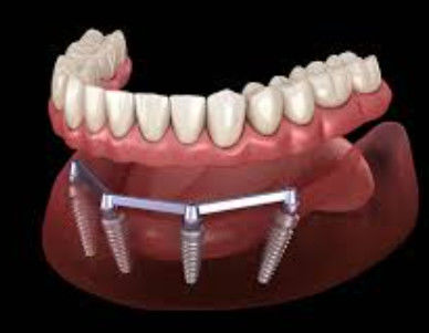 Sandblasted Denture Implant Bar Untuk Translucent dan Estetika Alami