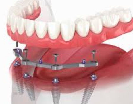 Full Arch Milled Titanium Bar Dental 12mm Panjang Dengan 2+ Attachments