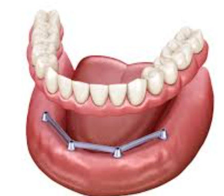 Screw Retained Translucence Implant Bar Denture Polished Surface Implant Bar