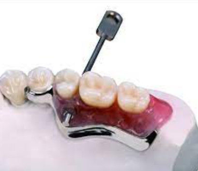 Mudah Pemasangan Kunci Dan Kunci Dental Attachment tahan oksidasi