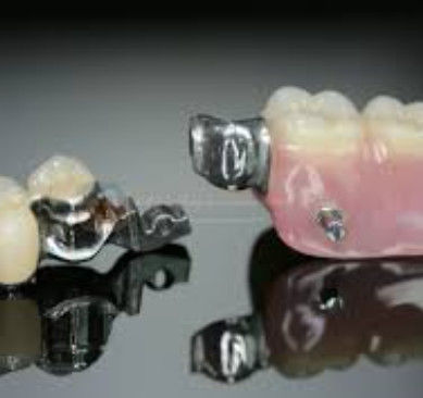 Fleksibilitas Tinggi Mk1 Attachment Dental Keakuratan Tinggi Dan Keamanan Untuk Menggunakan
